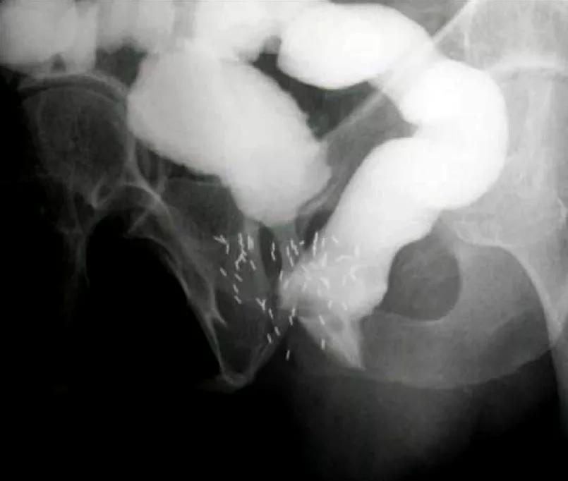Contrast study demonstrating rectourethral fistula.