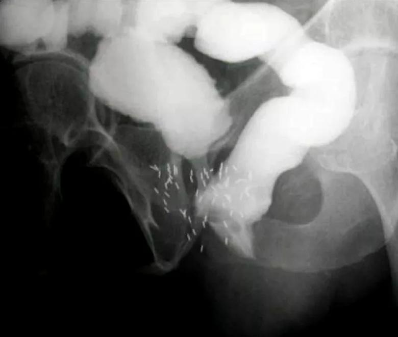 Contrast study demonstrating rectourethral fistula.