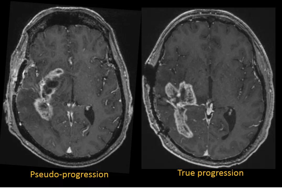 glioblastoma pseudoprogression versus true progression