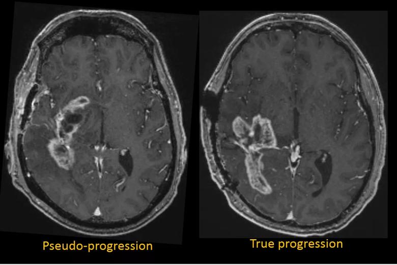 glioblastoma pseudoprogression versus true progression