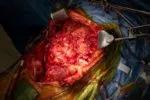 Extensive intra-abdominal tumors, including one encasing the patient's liver and another invading the bladder.