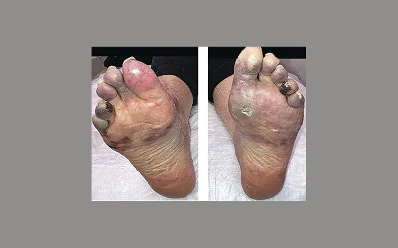 Patient's feet