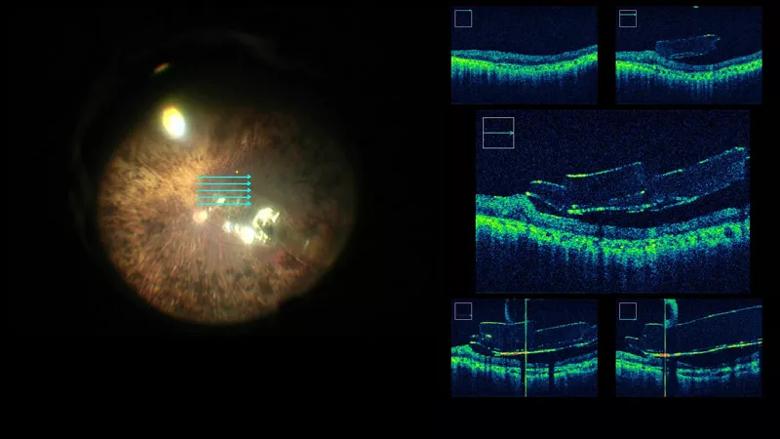 Intraoperative optical coherence tomography of the Argus II array