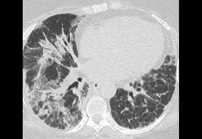 Lungs