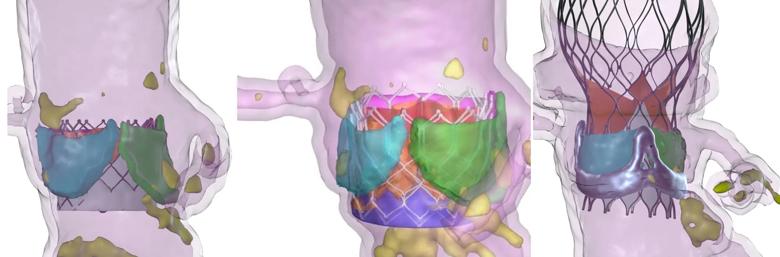 three colorful imaging models of heart valve procedures