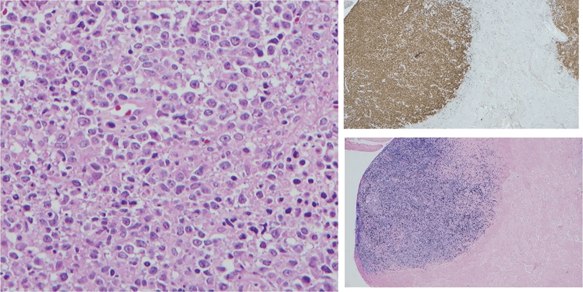 Figure 2. Pathology findings following synovectomy. (Above) Disruption of synovial tissue by an atypical lymphoid infiltrate composed of large cells with vesicular chromatin and multiple prominent nucleoli (H&E, 500× oil). (Top right) Cells positive for CD20 (CD20, 500× oil). (Bottom right) Cells positive for Epstein-Barr virus by chromogenic in situ hybridization (EBER-CISH, 500× oil). 