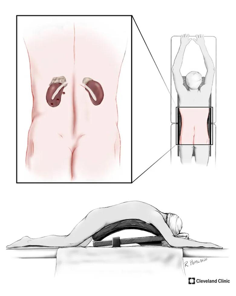 Medical illustration showing position of a patient for posterior approach adrenalectomy