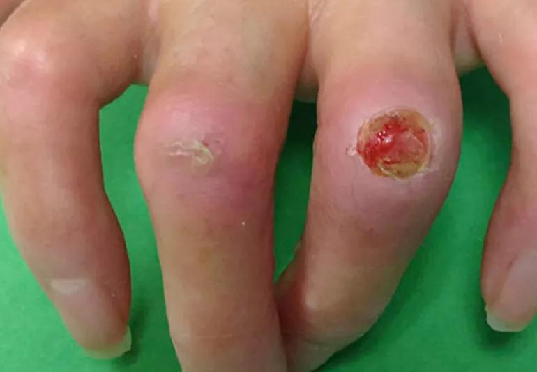 Scleroderma-Symptoms-Diagnosis-Treatment-Homeopathic-Conventiona-Allopathic-Dr-Qaisar-Ahmed-Risalpur-KPK-Pakistan