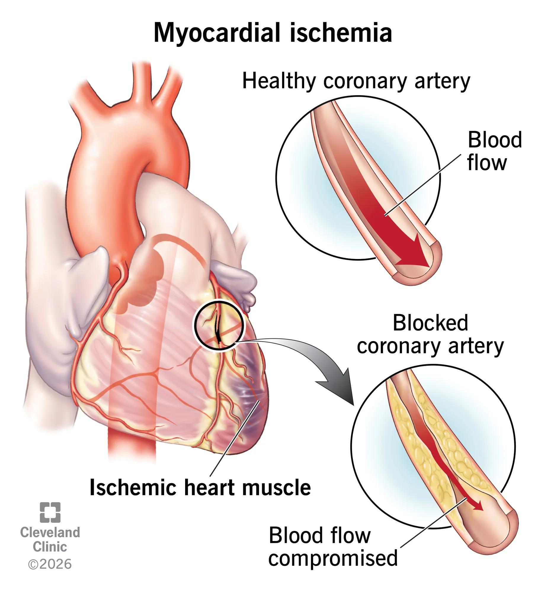 A healthy coronary artery and one with a blockage that causes myocardial ischemia