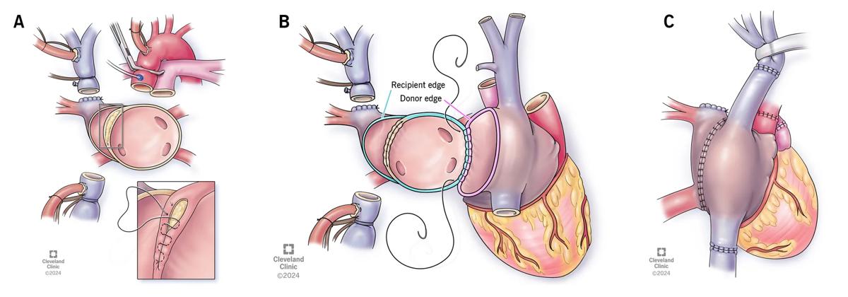 illustrations of three steps in a heart operation