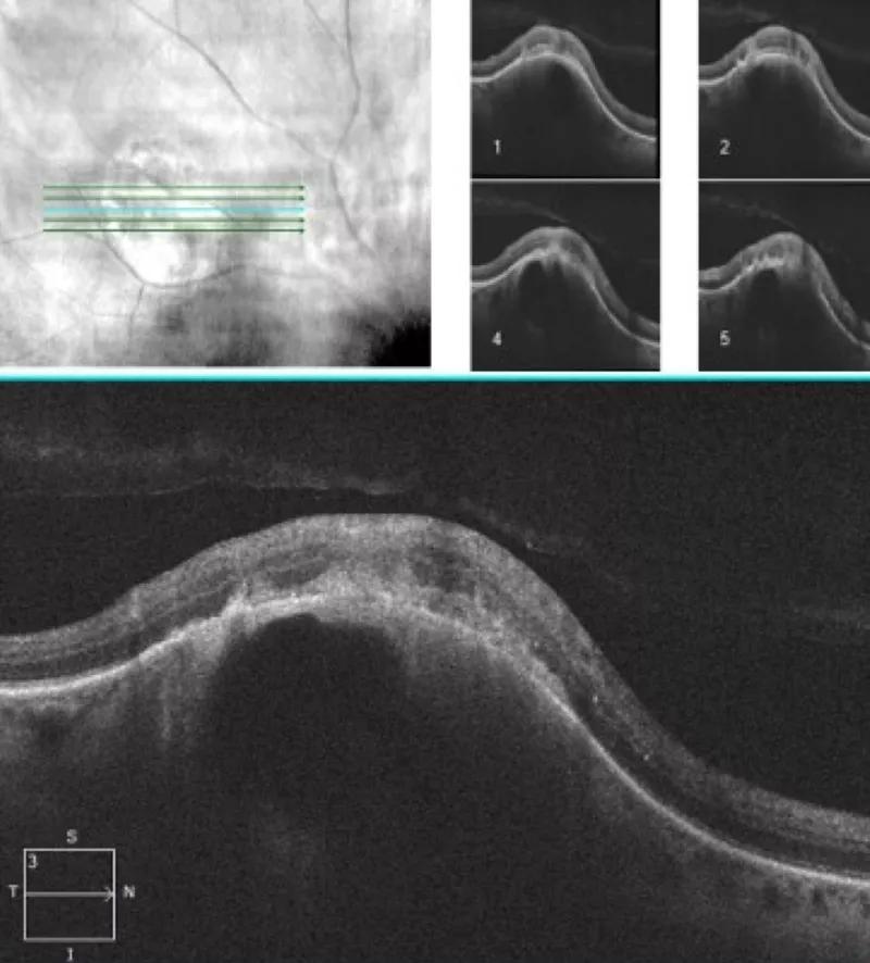 Eye