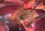 First-stage hepatectomy showing transection of the liver.