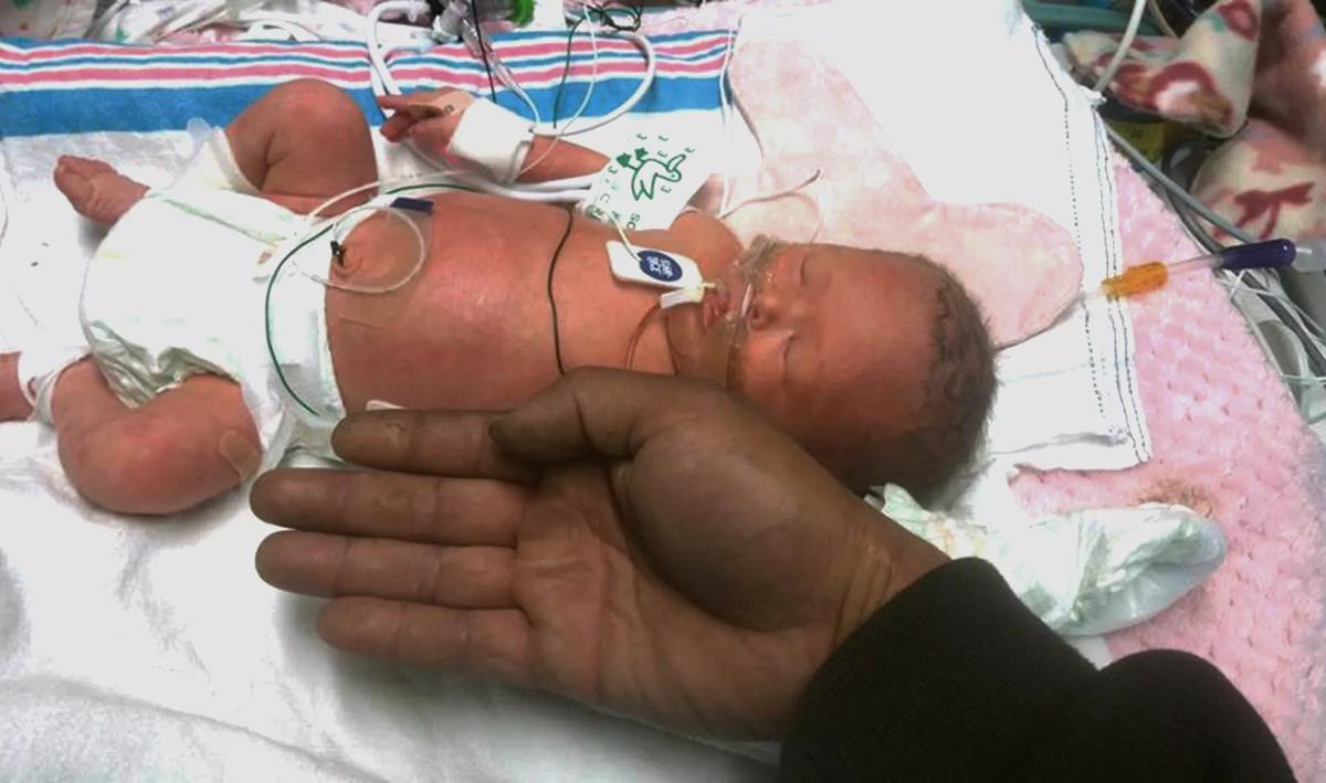 Cleveland Clinic Children's NICU leukemia
