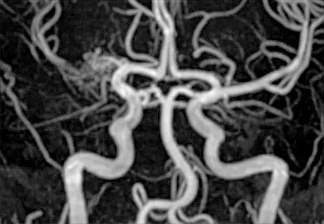 Cerebral Vasculopathy in Neurofibromatosis Type 1