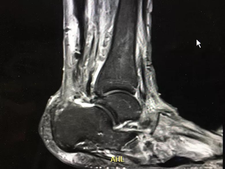 MRI