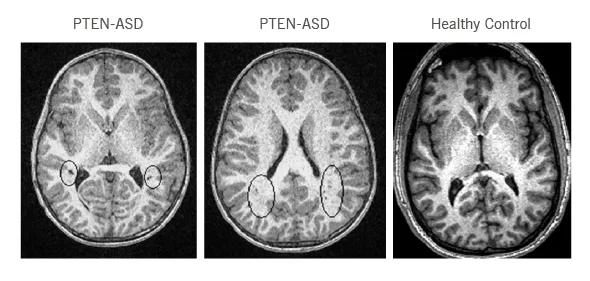 Figure 1. Brain scans showing white matter abnormalities in PTEN-ASD subjects but not in healthy controls. These types of imaging findings from our study suggest that reduced PTEN protein (strongly observed in PTEN-ASD subjects) seems to drive white matter abnormalities that, in turn, lead to IQ reductions.