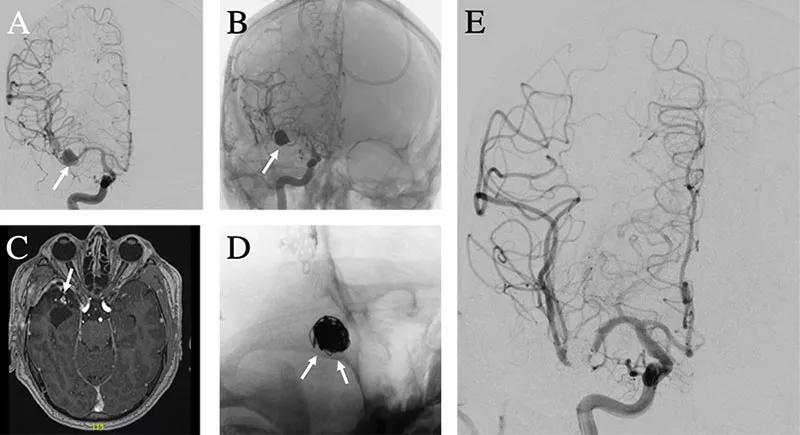 block of five scan images showing brains or blood vessels
