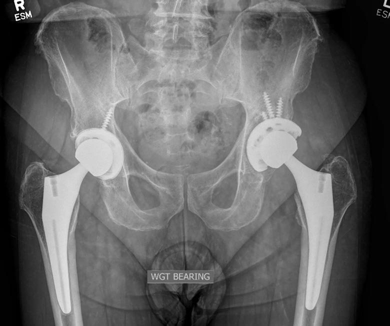 X-ray after hip revision surgery