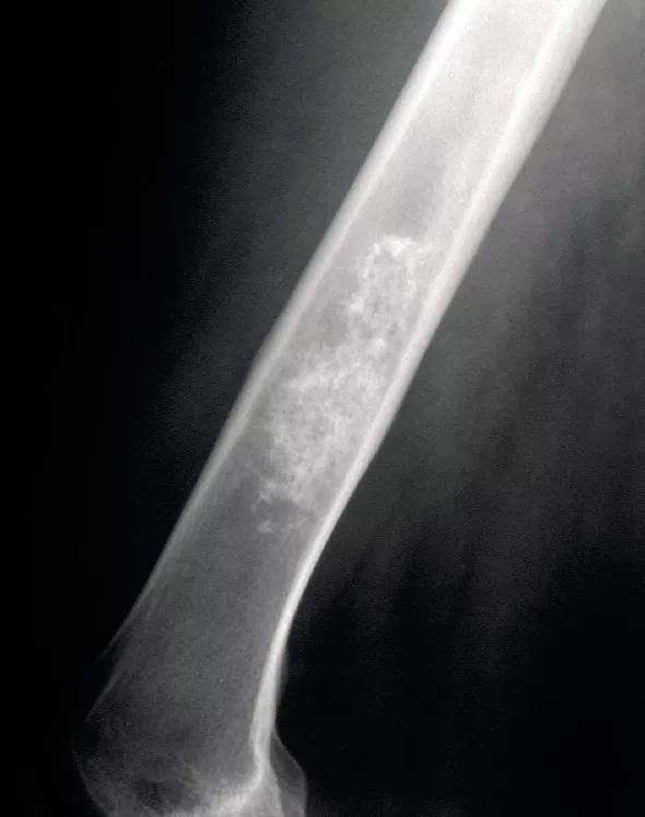 Figure 1. Lateral radiograph showing a distal femur enchondroma. Note the marked geographic borders and lack of periosteal or cortical changes.