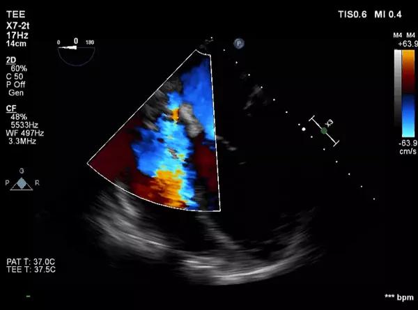 Figure 3. Echocardiogram showing tricuspid regurgitation with fluid compressing the right atrium and fluid around the left ventricle.