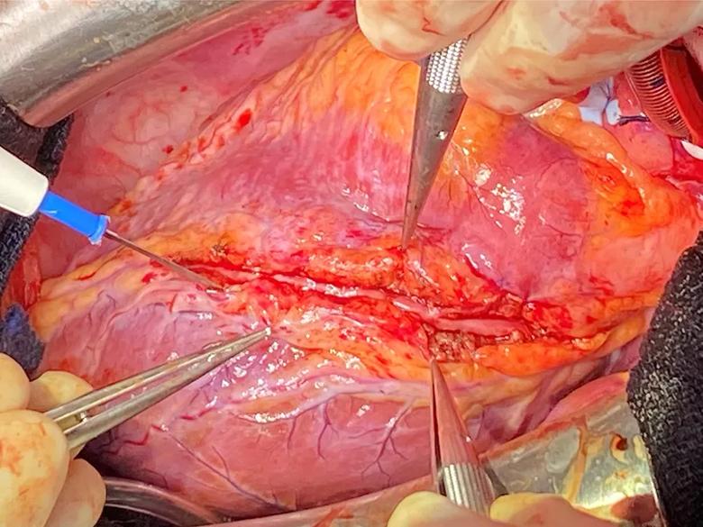Photo after completion of bridge unroofing of the left anterior descending artery.