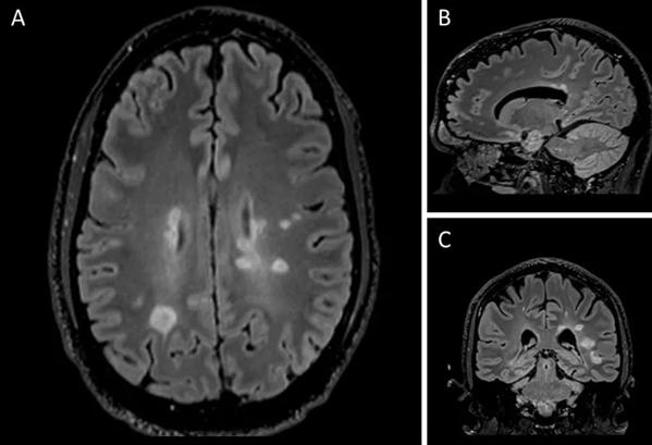 MS &#8211; CVS (crop) 20-NEU-1845659-CQD-Ontaneda_Grant-to-study-central-vein-sign-in-MS_805x1090-Inset-A