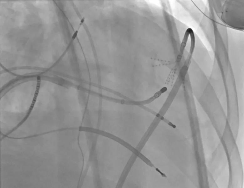 Simultaneous epicardial and endocardial mapping to locate the best ablation targets.