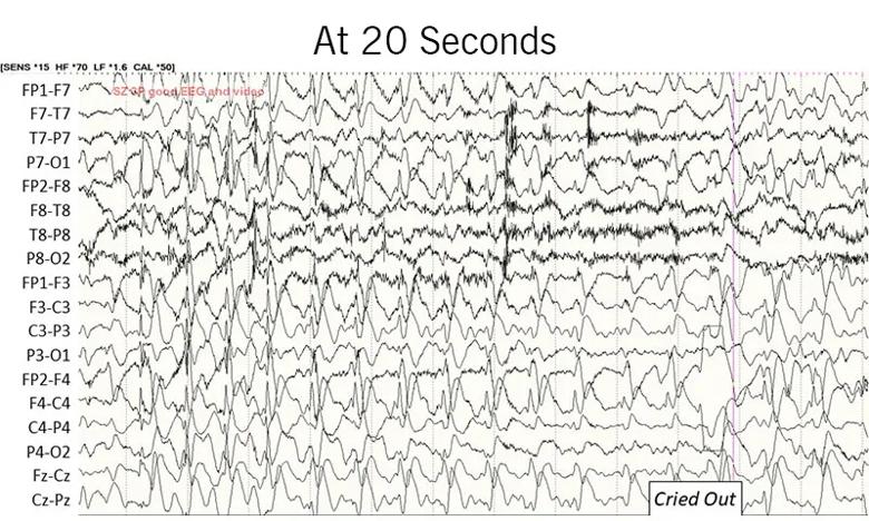 EEG recording