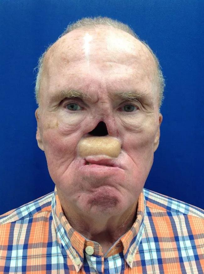 Case Study: Nasal Prosthetic