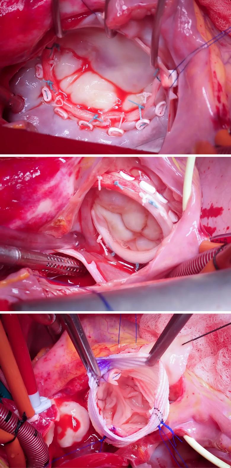 three stacked operative photos from heart valve surgery