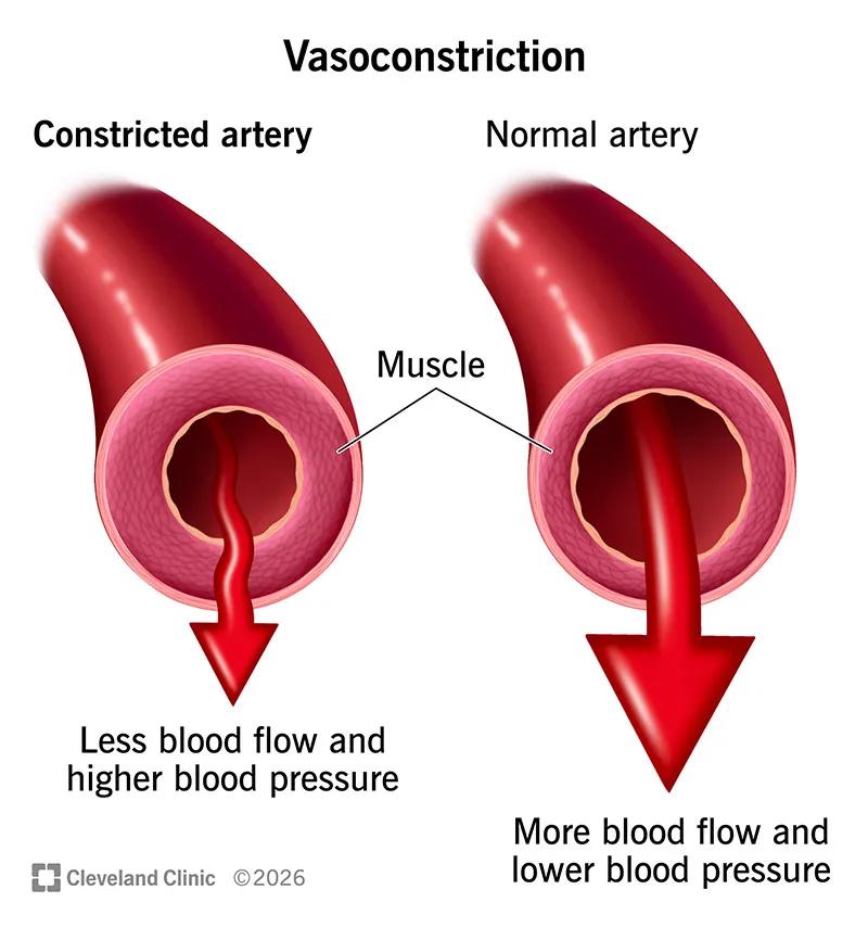 An artery with vasoconstriction compared to a normal artery