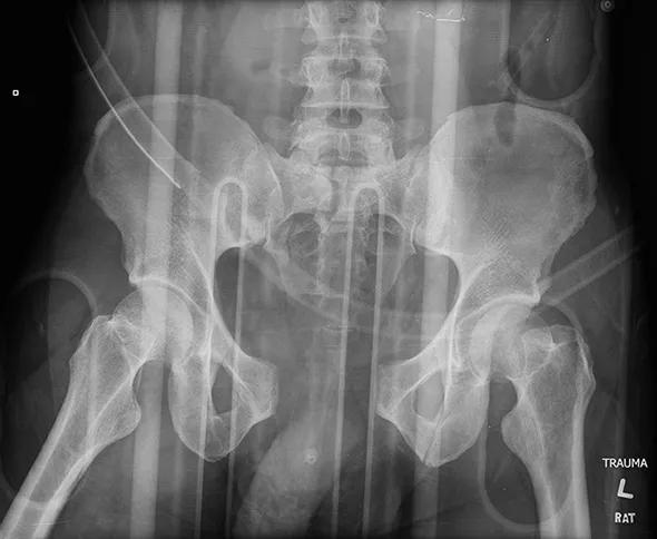 Figure 1. Anteroposterior pelvis injury film