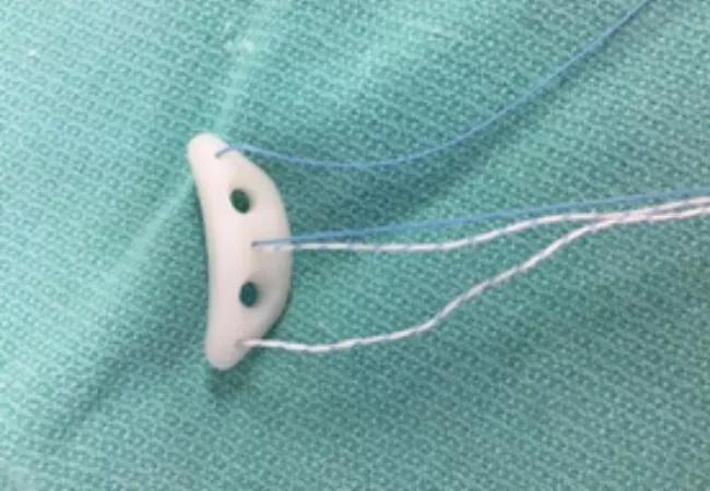 Example of preshaped, predrilled anterior glenoid allograft implants