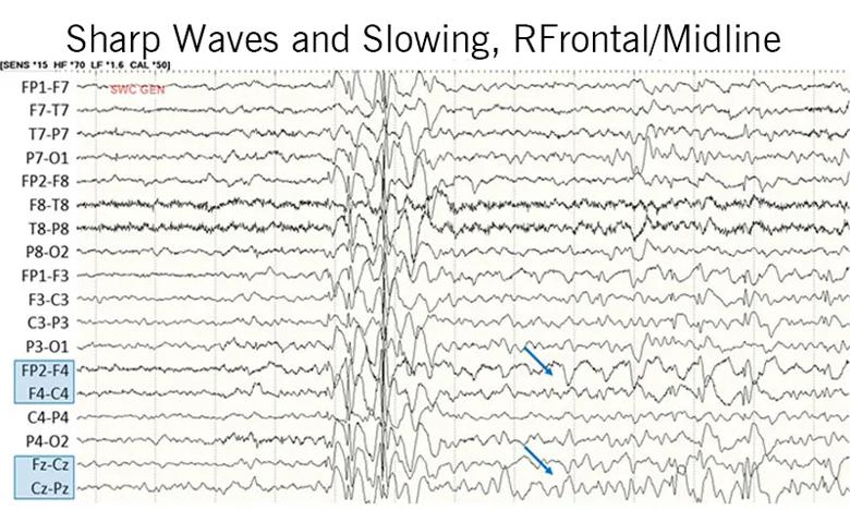 EEG recording