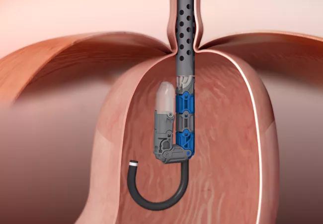 EsophyXTM device (EndoGastric® Solutions) inside with endoscope.