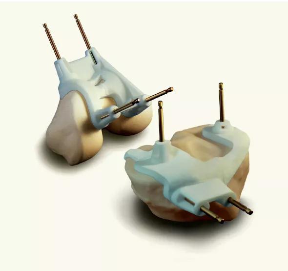 Figure. Patient-specific cutting guides pinned to models of the femur and tibia. Reprinted with permission from Zimmer. 