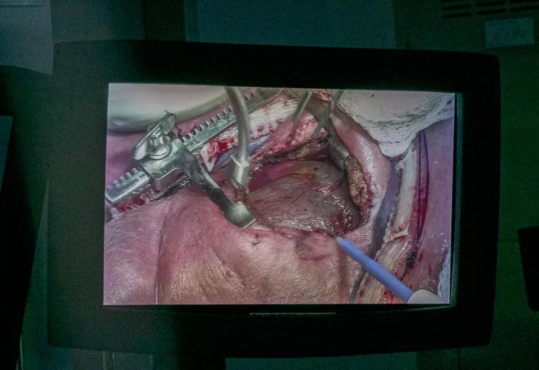 A monitor shows the opened fetal chest as Dr. Najm begins the tumor resection.
