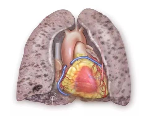 Figure 2. CABG performed prior to lung transplantation.