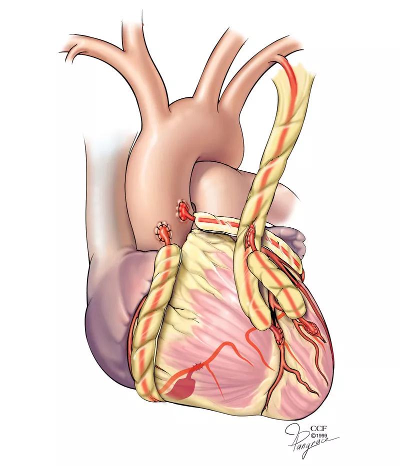 15-HRT-3041-Artierial-Graft-CQD-Inset
