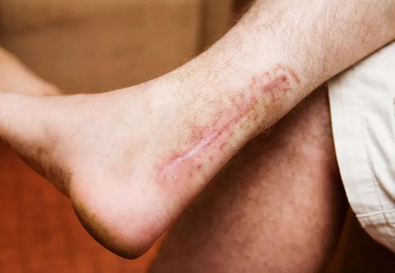Scars on legs
