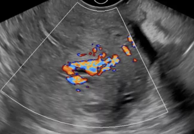 Scan shows 2.7-cm mass-like projection into the right anterolateral myometrium.