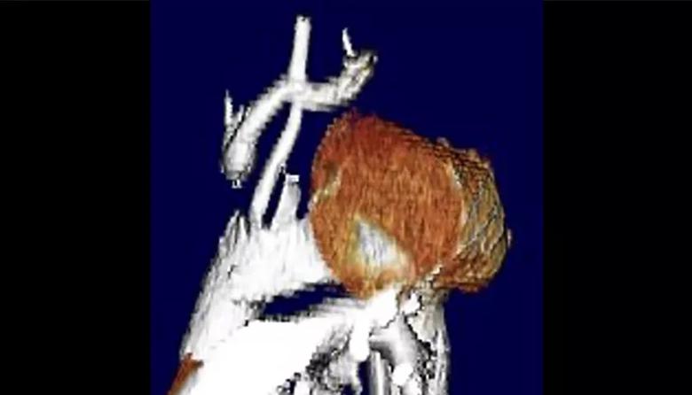 reconstructed supra-aortic branch vessels on 3D CT scan