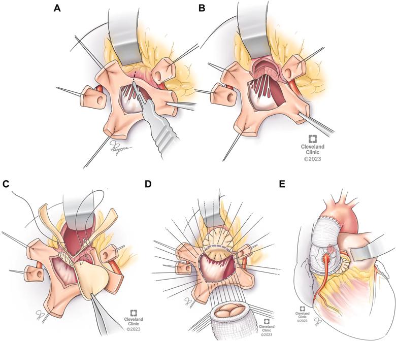 five-panel illustration of steps in a heart operation