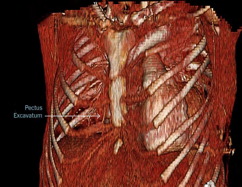 3D CT showing pectus excavatum