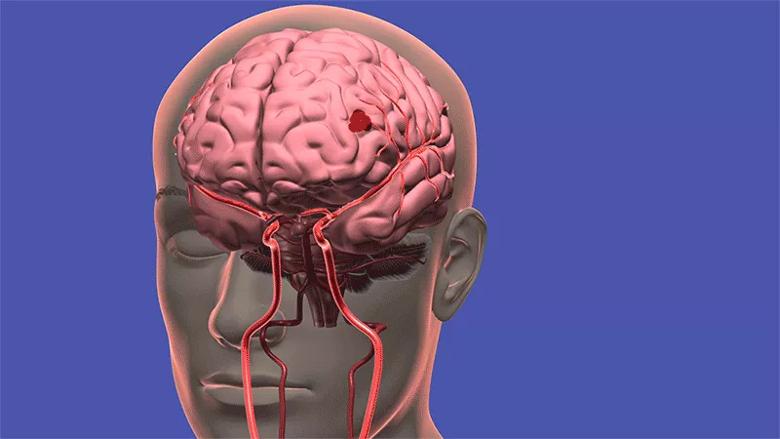 Cleveland-Clinic-Deep-Brain-Bleeds