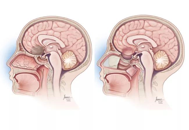 Figure. For a vascular pedicle nasoseptal flap, tissue from the nasal septum (dotted lines) is harvested and placed in the nasopharynx (left) until it can be used to cover a defect (right). 