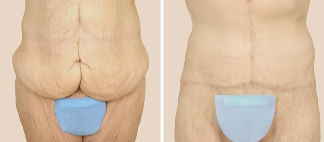 Before tummy tuck (left) and 13 months after tummy tuck (right).