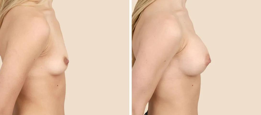 Breast augmentation before & after photo
