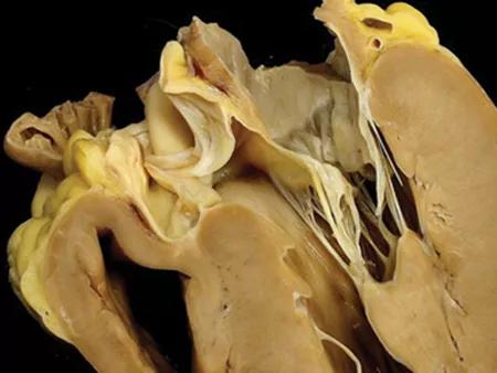 The case patient's explanted heart.