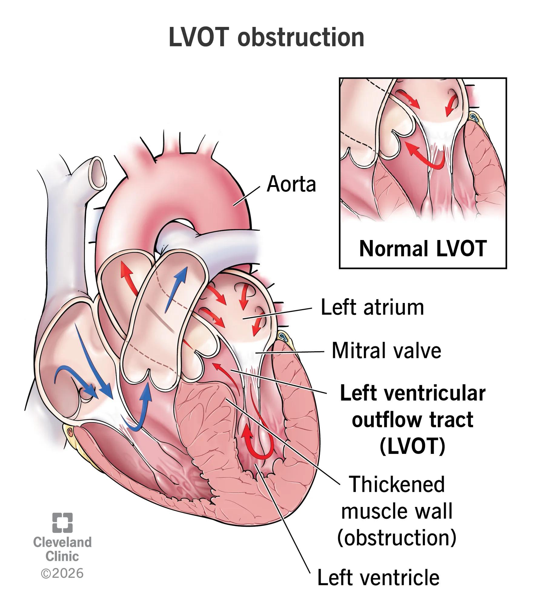 A normal heart’s LVOT compared to a heart with an LVOT obstruction